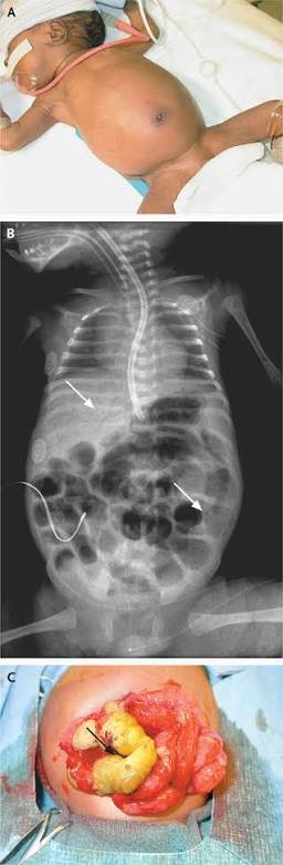 Necrotizing Enterocolitis