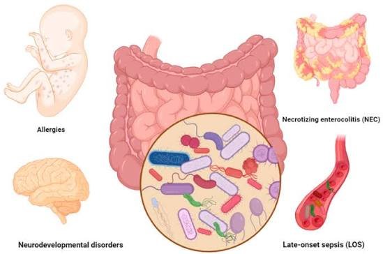 Premature Baby Gut Matters