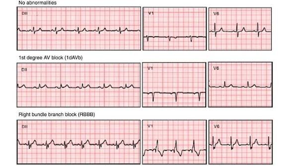 AI Analyze an ECG
