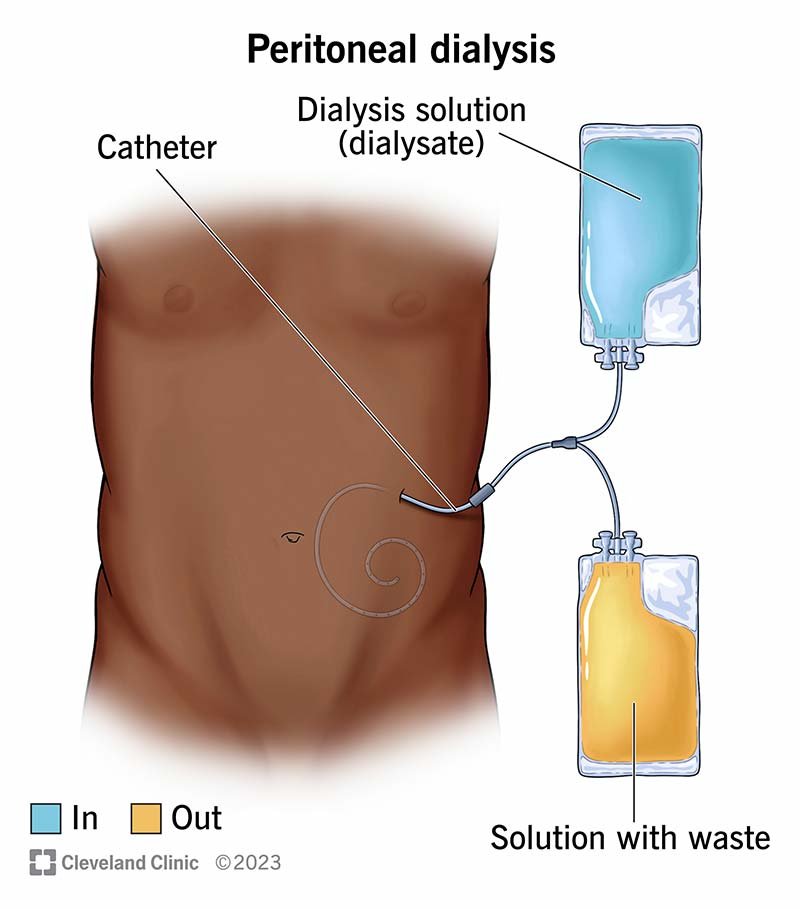 More Advanced Peritoneal Dialysis